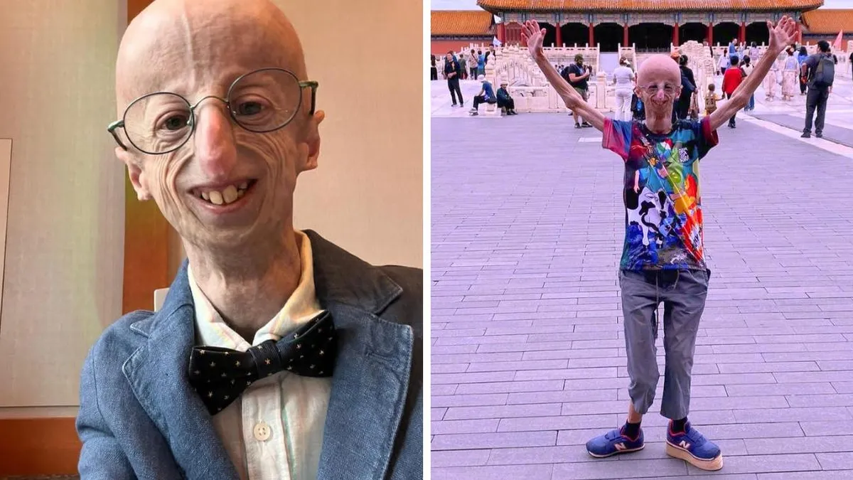 Fallece Sammy Basso, el joven que luchó por visibilizar la progeria y su impacto en la vida