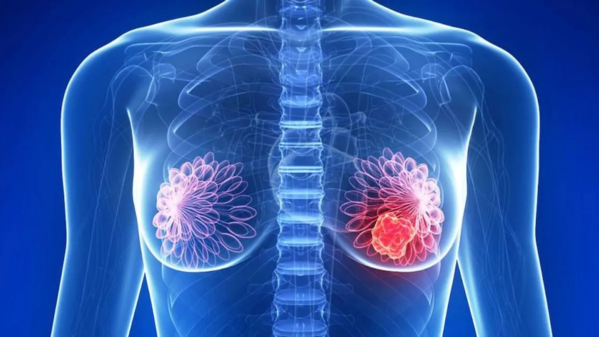 Genética y cáncer de mama: cómo las pruebas moleculares mejoran la prevención y tratamiento