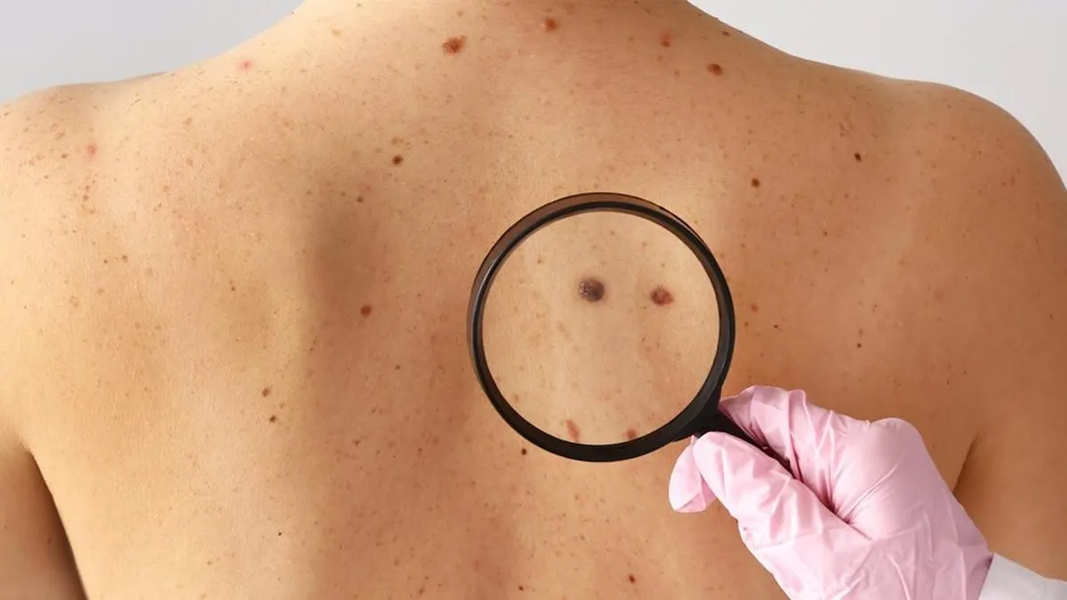 Cáncer de piel: estrategias clave para prevenir y detectar a tiempo esta enfermedad creciente