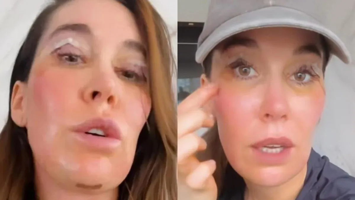 Vale Roth revela su experiencia con dos procedimientos estéticos en el rostro: "Es invasivo".