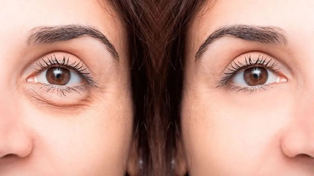 Descubre los mejores remedios caseros para eliminar las ojeras de forma efectiva.