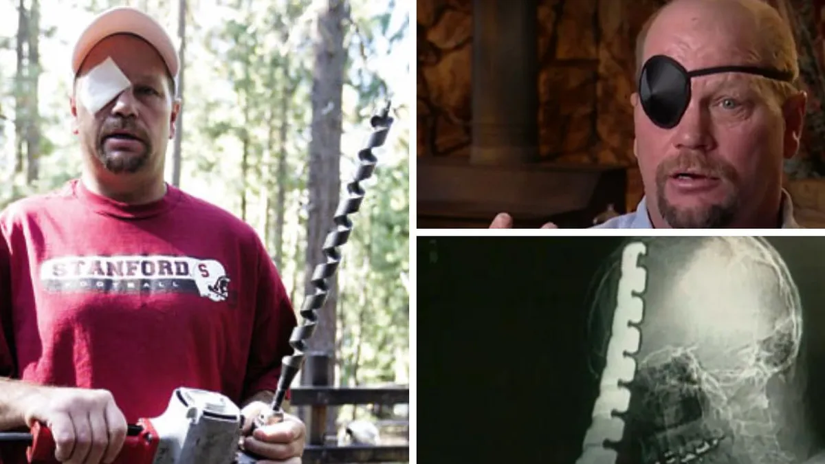 Increíble historia de supervivencia: hombre atraviesa su cabeza con una broca de 45 cm