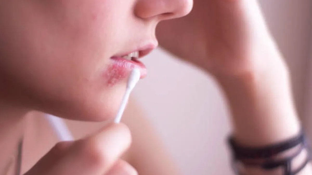 Herpes labial: incómodos brotes y la búsqueda de un tratamiento efectivo sin cura definitiva