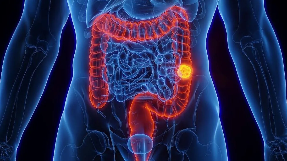 Nuevo modelo predice riesgo de cáncer colorrectal en jóvenes menores de 45 años