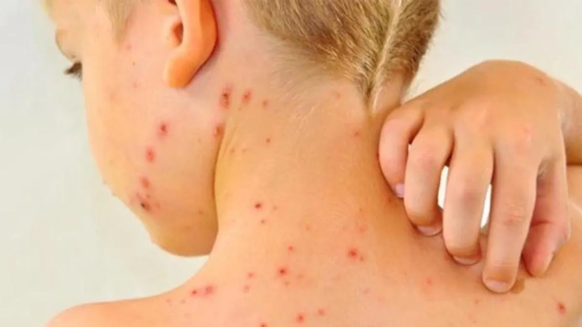 Estrategia de vacunación ante el aumento de casos de sarampión en el país.