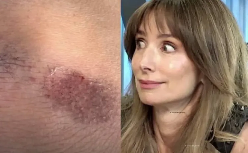 María José Prieto revela su accidente en scooter y alerta sobre la falta de señalización en las calles