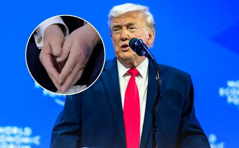 Trump aclara el origen de sus moretones: un corte y aspirina