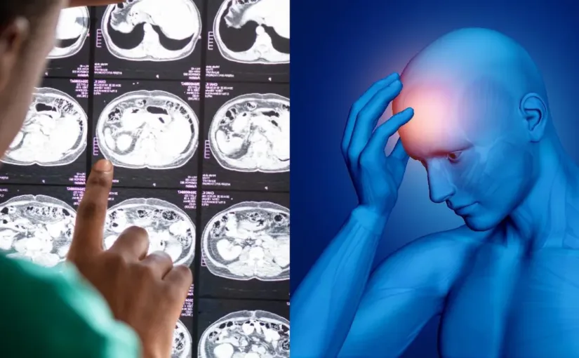 El ACV es una emergencia médica; reconocer sus síntomas es vital para actuar a tiempo.