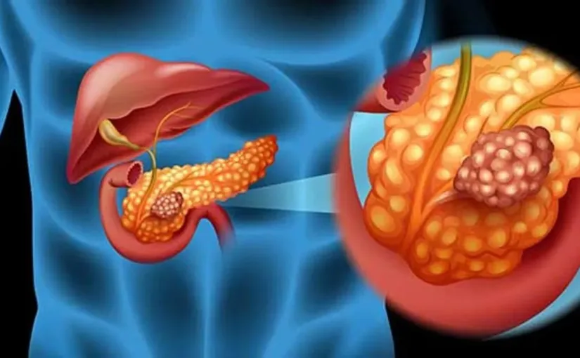 Científicos españoles eliminan el cáncer de páncreas en ratones con nuevos compuestos.